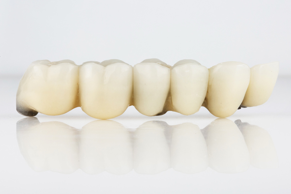 Dental bridge: five porcelain teeth.